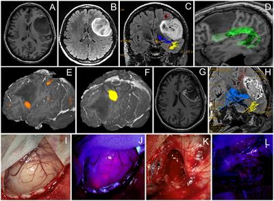 5-ALA-guided tumor resection during awake speech mapping in gliomas located in eloquent speech areas: Single-center experience